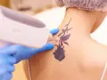 Usuwanie tatuażu z wzorem chemicznym za pomocą lasera.