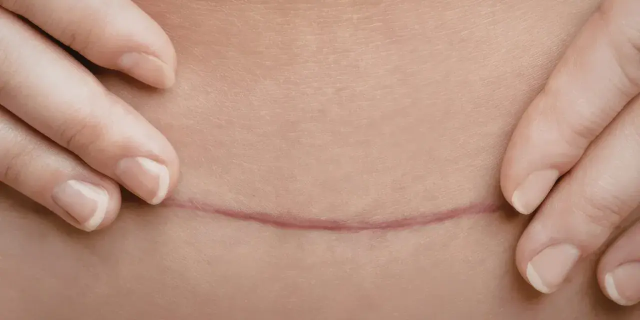 Dłonie delikatnie odsłaniają poziomą bliznę po cesarskim cięciu, przypominającą pionowy labret blizna.