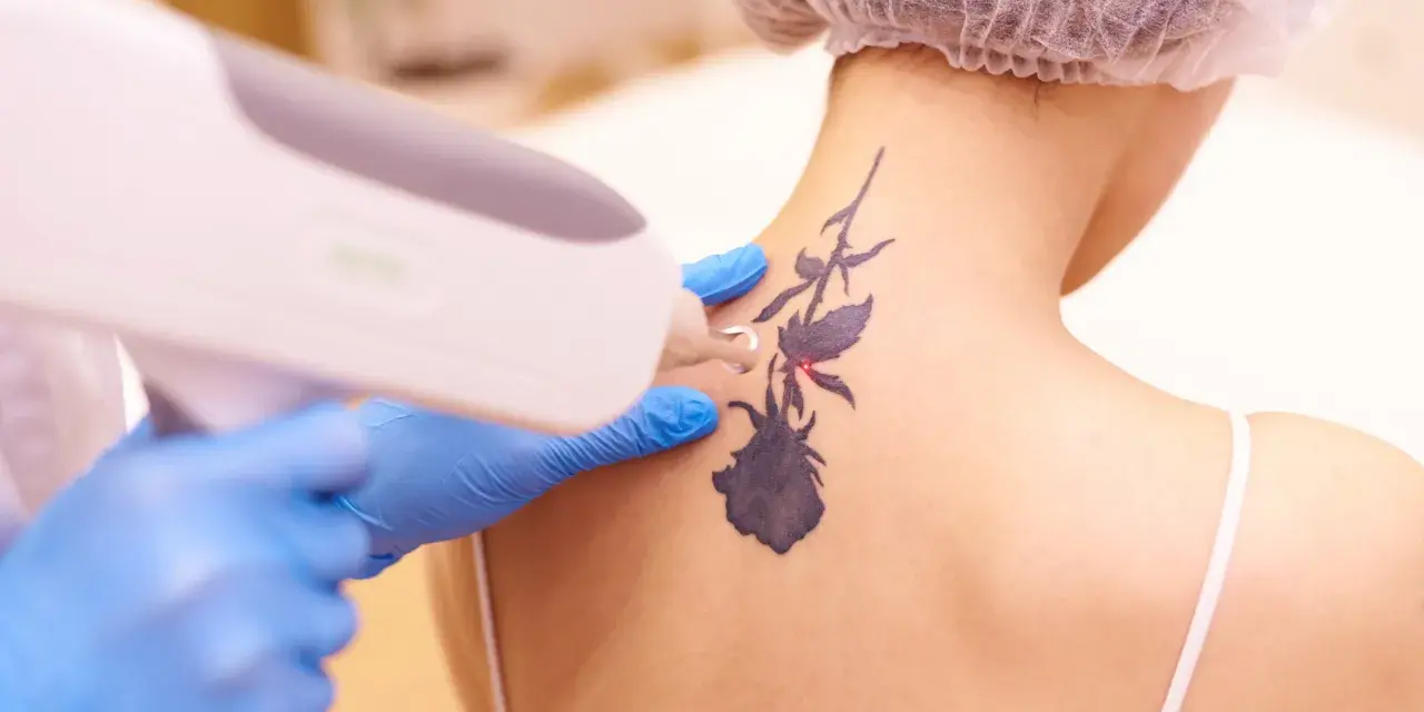 Usuwanie tatuażu z wzorem chemicznym za pomocą lasera.