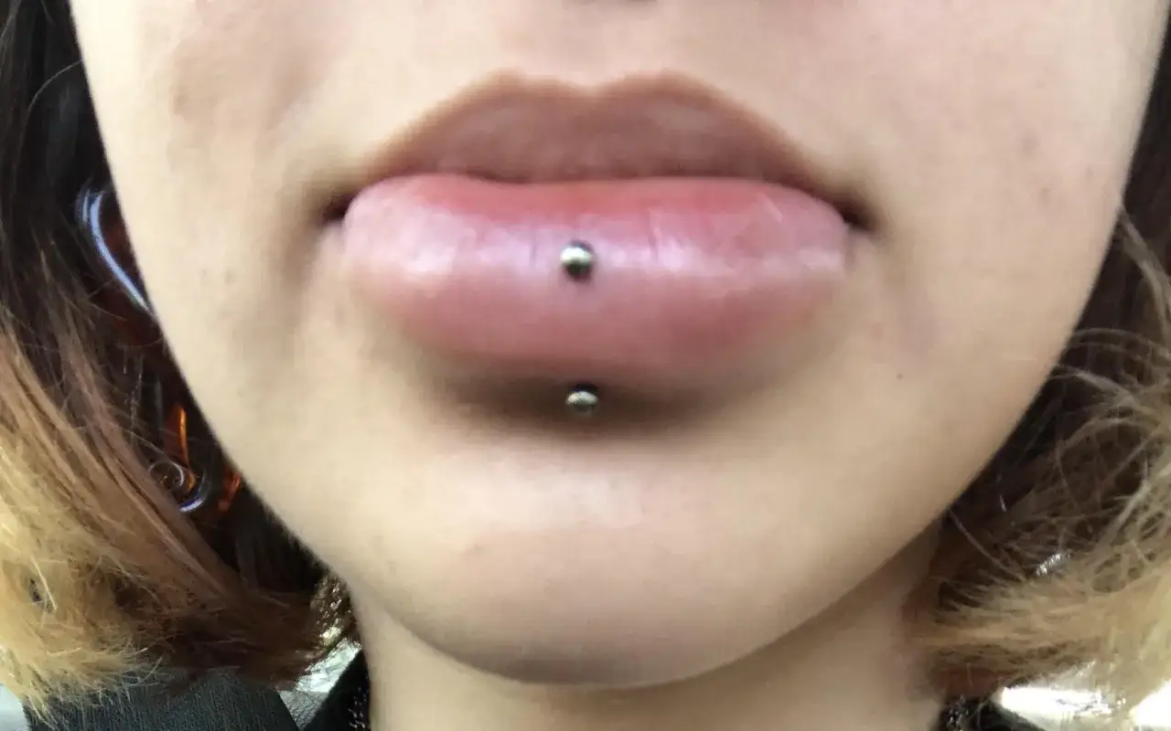 Zbliżenie na usta z pionowym labretem. Widoczne są dwa srebrne k&oacute;łka, jedno na g&oacute;rnej wardze, drugie na dolnej. Proces vertical labret gojenie w toku.