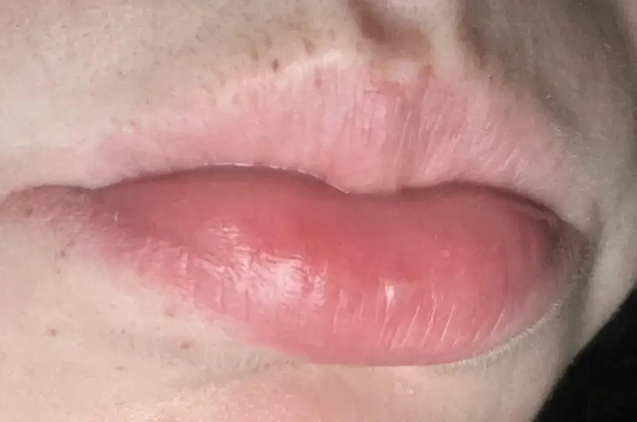 Zbliżenie na usta z widoczną pionową blizną po kolczyku typu vertical labret.